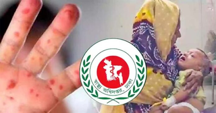 ham হামের উপসর্গে আরও ৩ শিশুর মৃত্যু, নতুন আক্রান্ত ৭৮৬